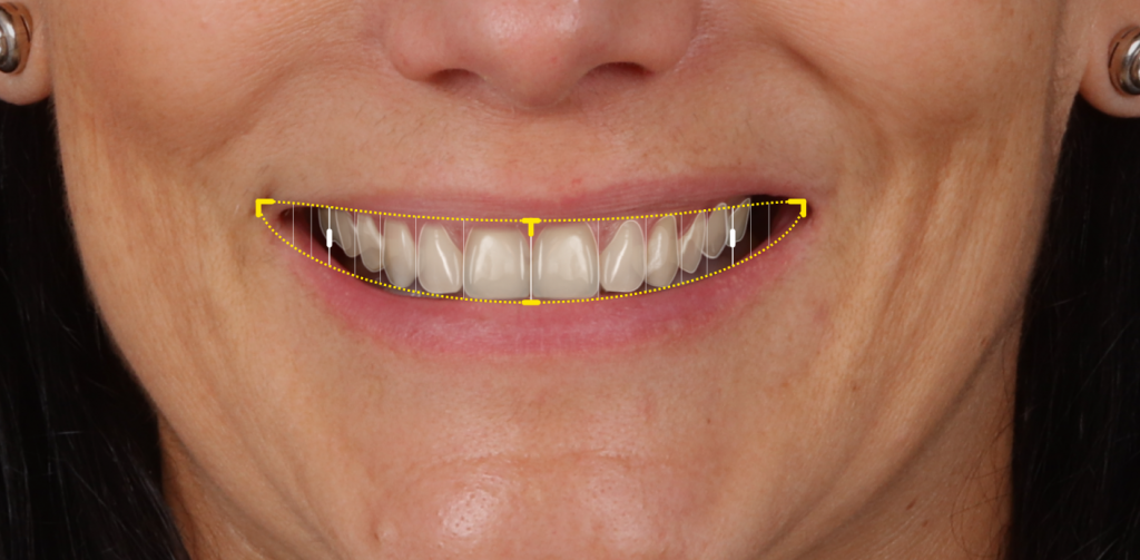 Diseño digital de Sonrisas NextGen