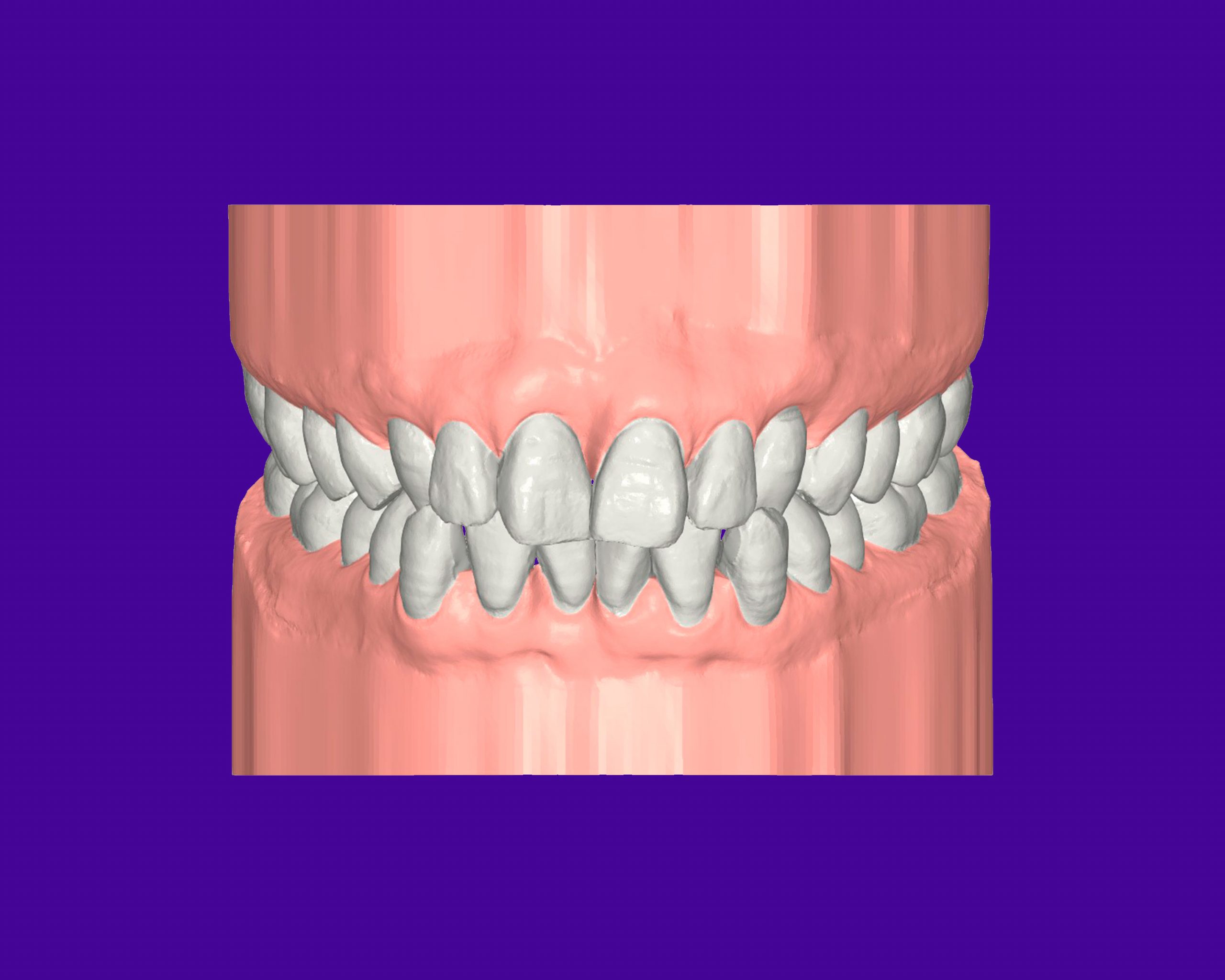 maloclusion clase I