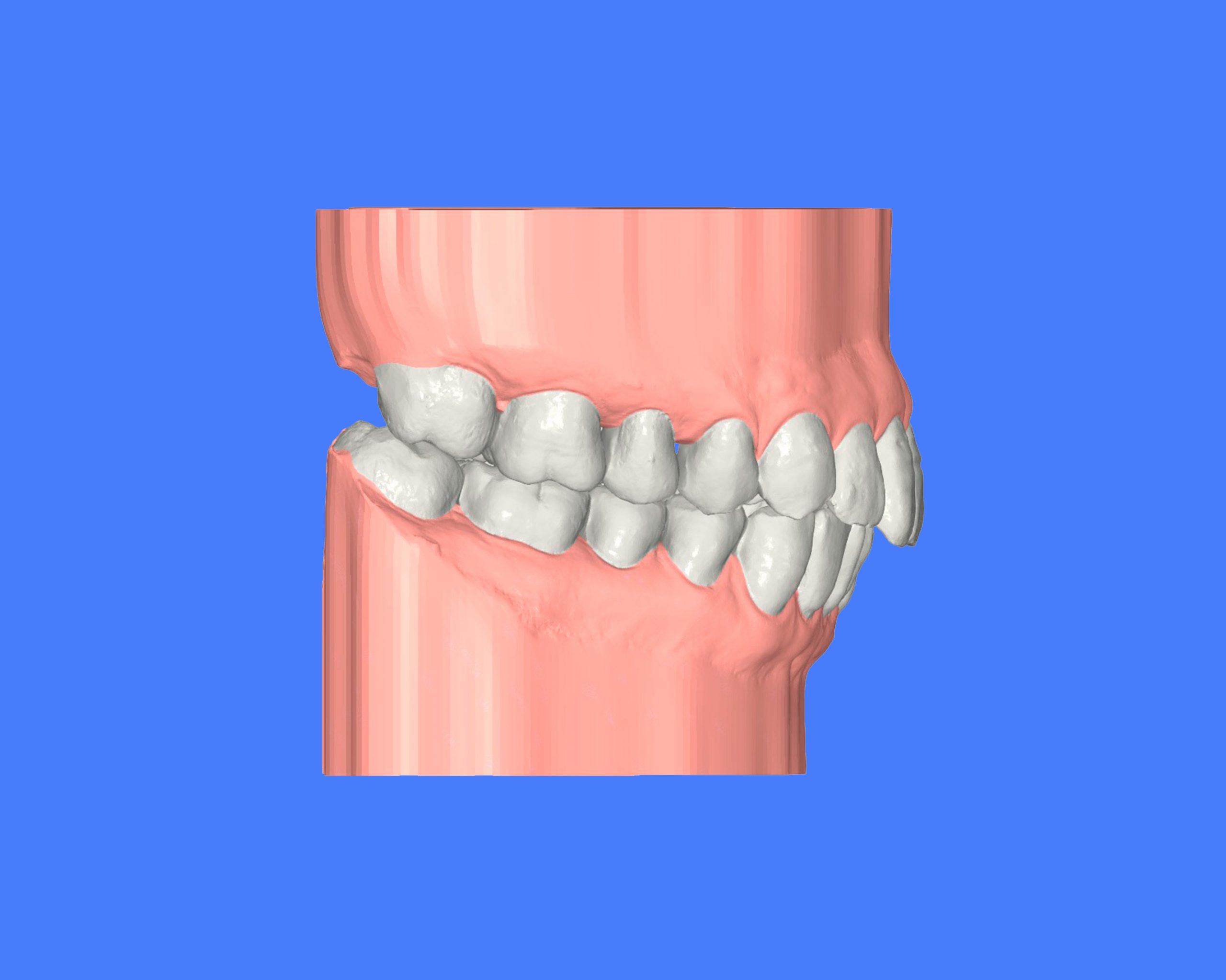 maloclusion clase II