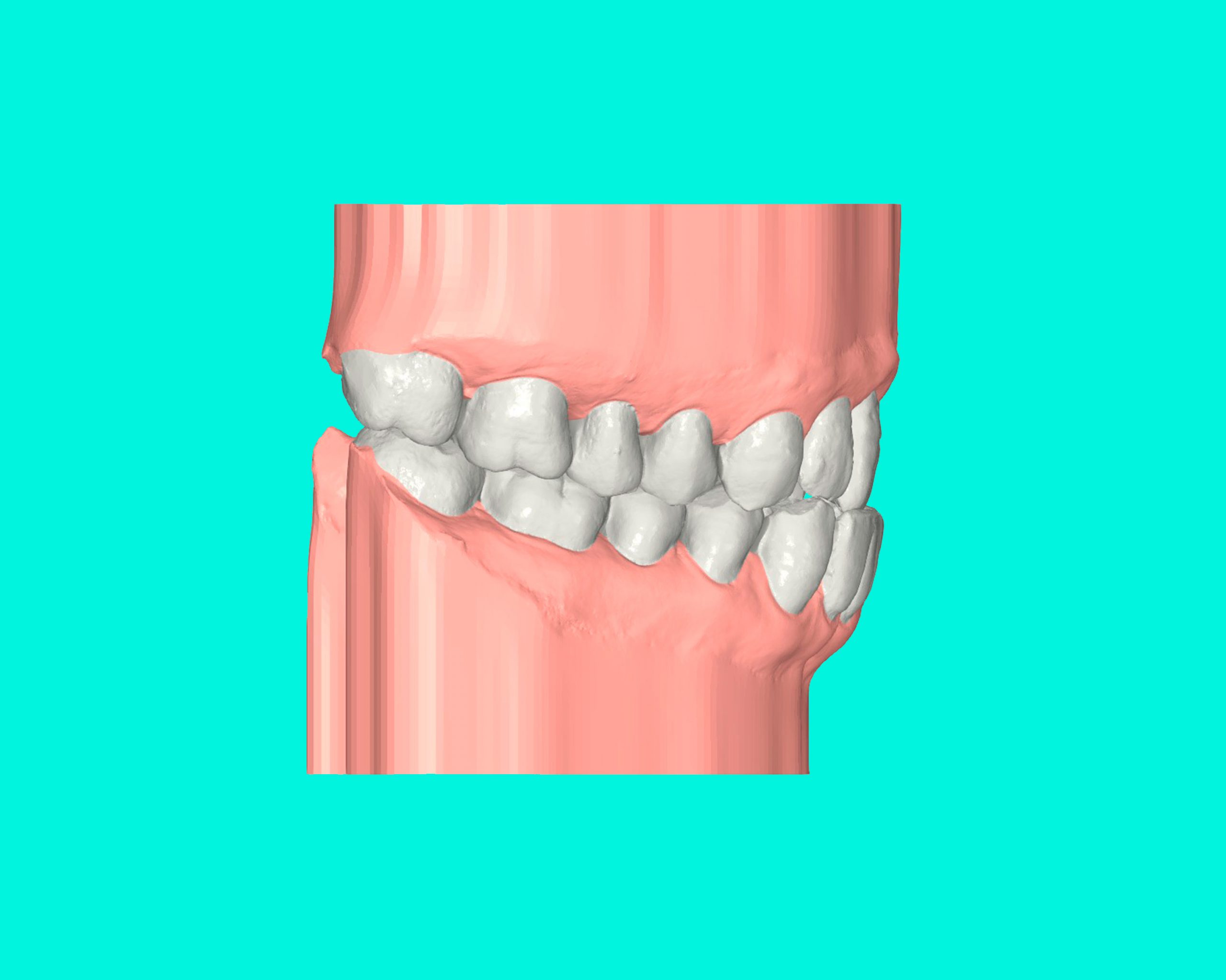 maloclusion clase III