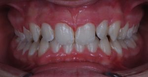 ORTODONCIA INFANTIL DESPUÉS