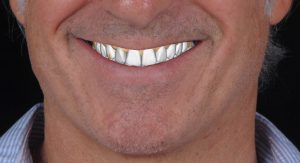 MOCK UP previo - tratamiento Caso JRA RA