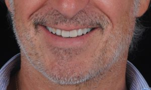 resultado final tratamiento Caso JRA - estética