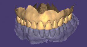 MOCK UP previo - tratamiento Caso DVP